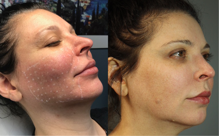 Juvederm Volite Before After Photo